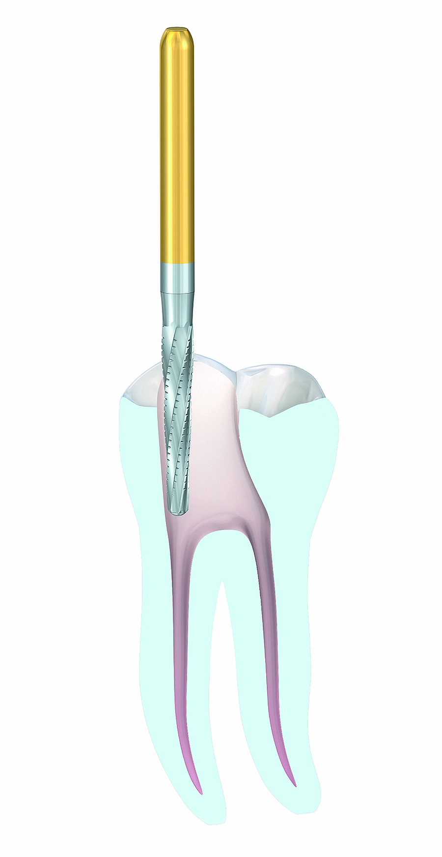 Entscheidende Teilschritte bei der Präparation der endodontischen Zugangskavität