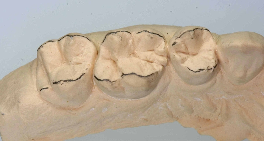 Aufwachstechnik TPK Modellation Zahn 16