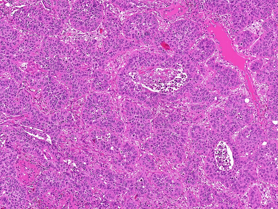 Maschinelles Lernen verbessert die Diagnostik bei Patienten mit Kopf-Hals-Tumoren