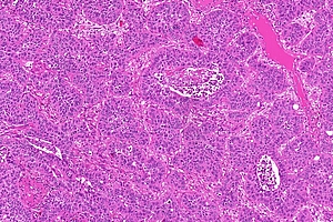 Maschinelles Lernen verbessert die Diagnostik bei Patienten mit Kopf-Hals-Tumoren