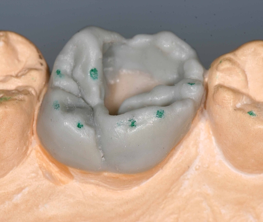 Crista transversa, Stampfhöcker, Modellation der Kaufläche