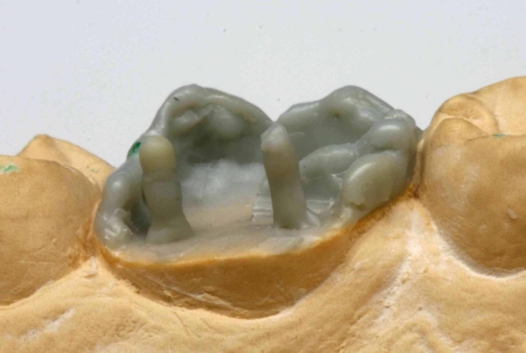Aufwachstechnik TPK Modellation Zahn 16